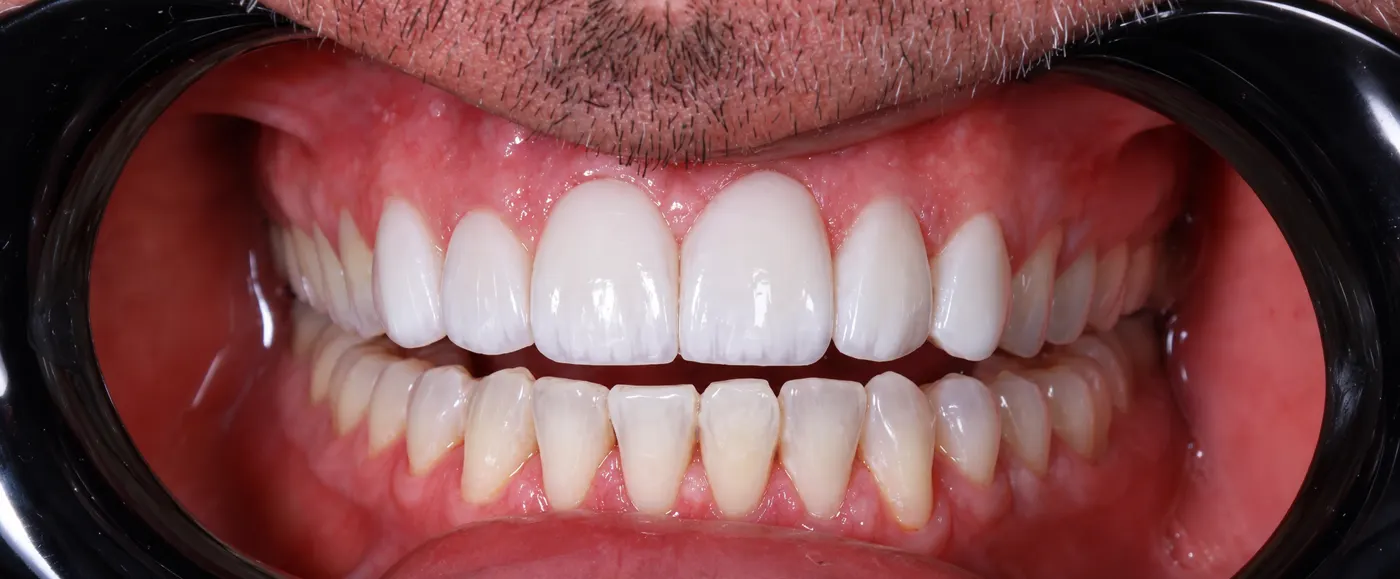 After: upper veneers