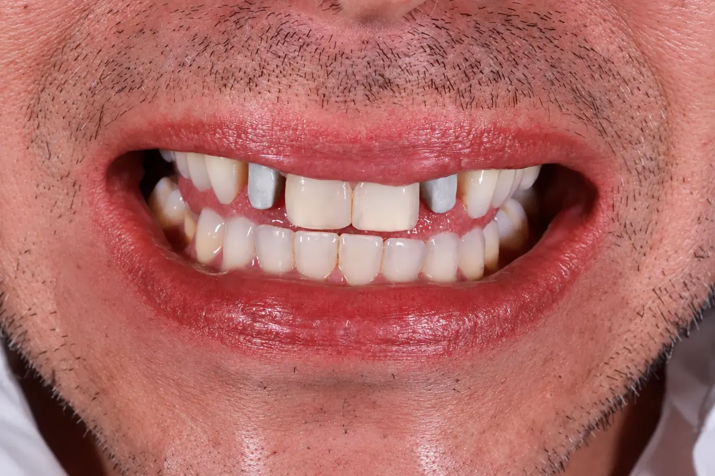 Before: worn and prepared teeth