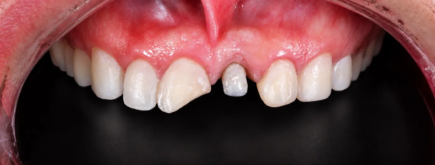Missing front tooth before treatment