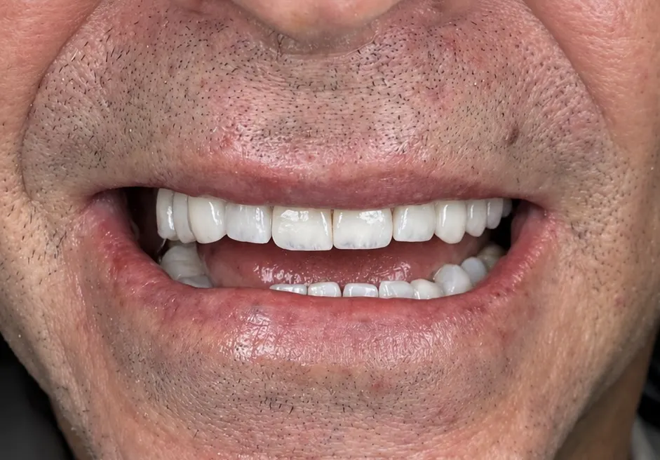 After: full porcelain smile