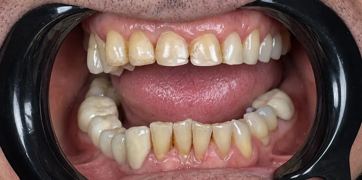 Before: worn, yellowed teeth