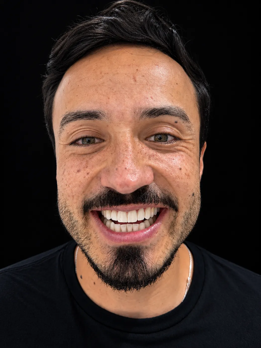 Patient smiling after porcelain veneers
