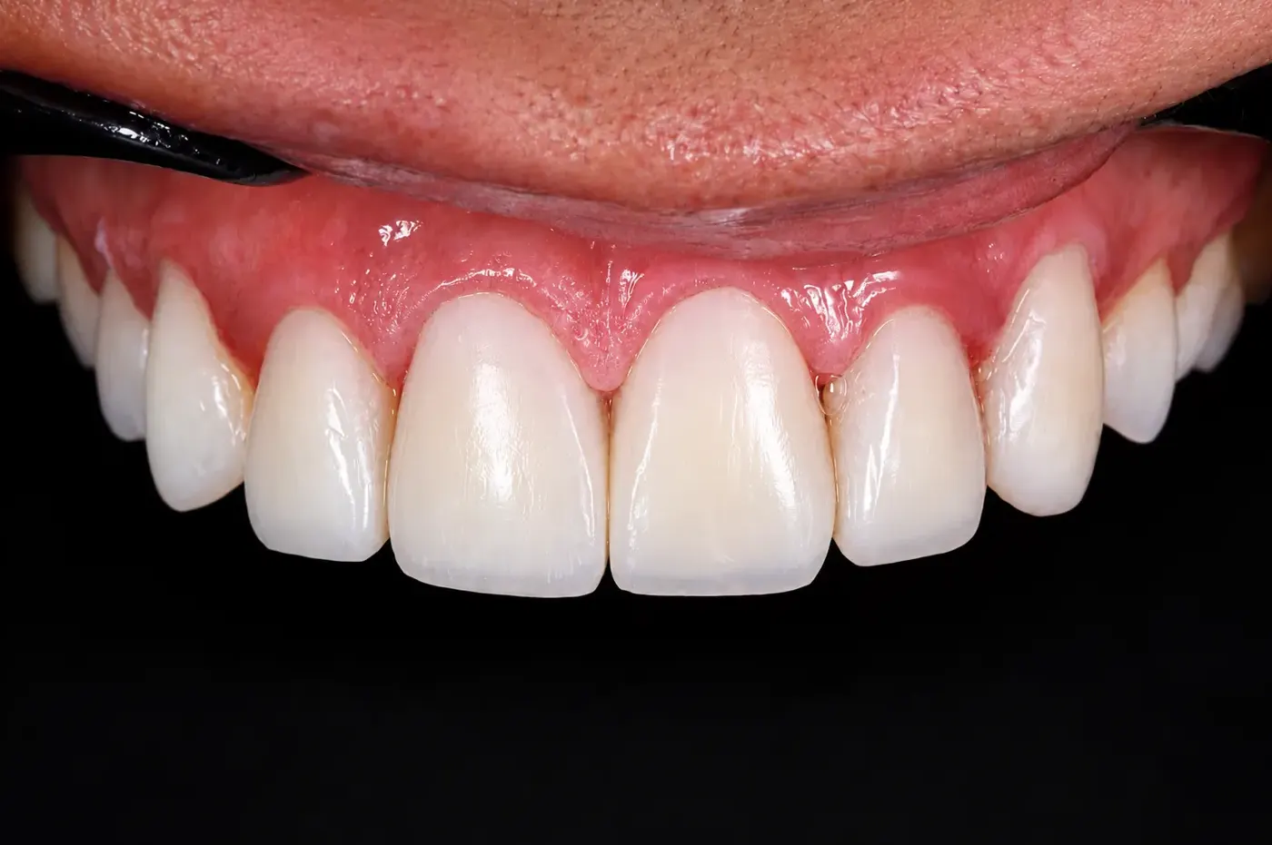 After: even, natural upper teeth
