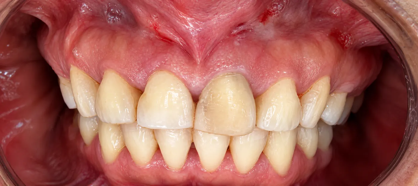 Before: one dark front tooth